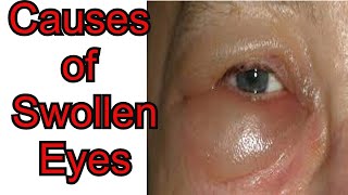 How to Cure Swollen Eyes Overnight  You Wont Believe The Results [upl. by Nakasuji817]