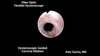 Hysteroscopicguided cervical dilation [upl. by Fiann]