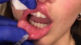 Dissolving Lip Filler by Dr Kassir [upl. by Profant161]