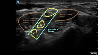 Ultrasound guided interscalene and supraclavicular brachial plexus block [upl. by Arabel]