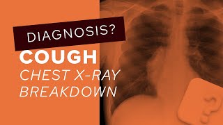 Chest XRay breakdown How to assess the posterior mediastinum on Chest XRay [upl. by Naro]