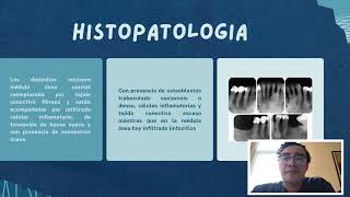 Osteitis Condensante [upl. by Doreen]