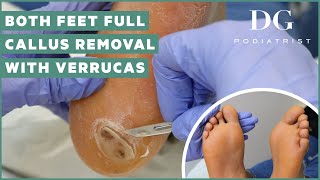 Callus removal from feet both feet and three verruca plantar warts treatment [upl. by Earb404]