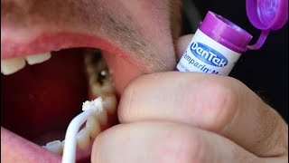 How To Fix a Broken Tooth with Dentemp or DenTek Tooth Filling and Crown Repair [upl. by Lyn]