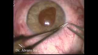 Fixação de Lente Intraocular Subluxada e Pupiloplastia  Dr Álvaro Sá [upl. by Sherborne]