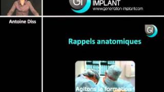 Implant dentaire  Rappels anatomiques [upl. by Susanna316]