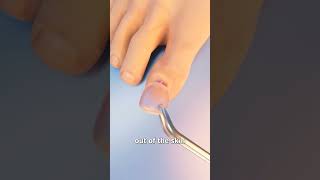 How Toenail Removal Works 😬 [upl. by Chad]