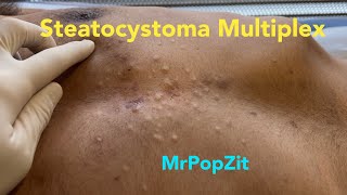 Steatocystoma Multiplex Dozens of extractions on the chest Chronic condition MrPopZit [upl. by Auqinot294]