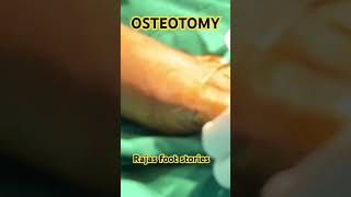 OSTEOTOMY [upl. by Dumas]