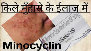 TabMinolox  Minocycline100Mg UsesBenifitsDoseMrp And Side effectMinocyclin का प्रयोग [upl. by Aiciruam]