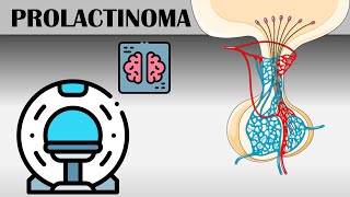 Prolactinoma  Causes Risk Factors Signs amp Symptoms Diagnosis And Treatment [upl. by Fitzgerald]