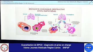 Exacerbation BPCO  diagnostic et prise en charge 27 Juin 2024 [upl. by Brock]