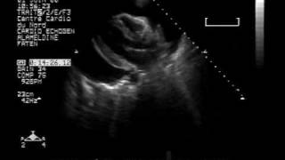 echocardiogram massive1 pericardial effusion with cardiac tamponade long axis view [upl. by Eikcuhc]