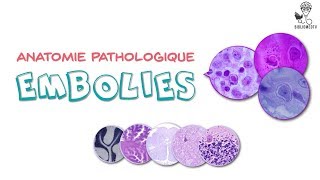 Anatomie Pathologique  les Embolies [upl. by Aihsas]