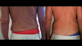 Tummy Tuck NO SURGERY  4073742114 [upl. by Egiedan]