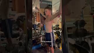 Teenager Pectus Excavatum Transformation Exercise amp Surgery [upl. by Lrat131]