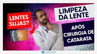 Capsulotomia com YAG laser limpeza da lente após cirurgia de catarata  Dr Gustavo Bonfadini [upl. by Soane]