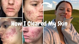 How I Cleared My Severe Cystic Acne Accutane Experience  Minocycline Autoimmune Allergic Reaction [upl. by Krug748]