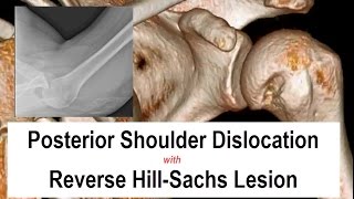 Posterior Shoulder Dislocation Reduction [upl. by Kaya]