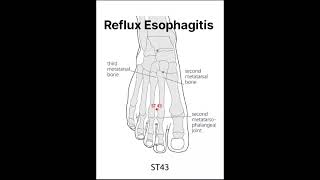 Reflux Esophagitis Acupressure points shorts acidity [upl. by Esinaej898]