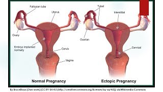 RCOG Guideline Diagnosis and Management of Ectopic Pregnancy No21 [upl. by Shelley447]