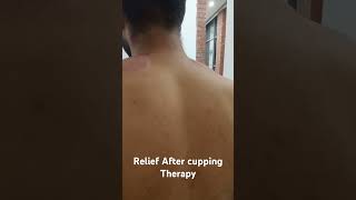 Trapezitis pain relief after cupping therapy physiotharapy sportsinjurytreatment health cupping [upl. by Akinimod]