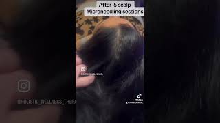 Scalp Microneedling for hair growth hair loss treatment [upl. by Grimbal]