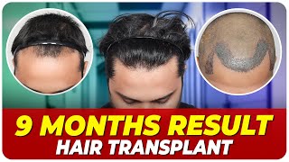 Hair Transplant Time Lapse  Step by Step Hair Transplant Surgery Time Lapse [upl. by Inattirb]