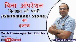 पित्ताशय की पथरी Gallbladder Stone का बिना ऑपरेशन के इलाज  Yash Homeopathic Center [upl. by Alien]