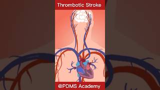 Stroke  Ischemic stroke pathology disease [upl. by Natalina]