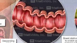 Bowel Perforation [upl. by Direj]