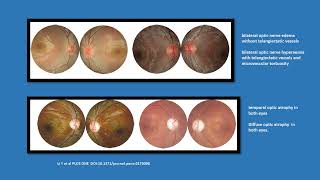 Neurology Quiz 98 Lebers hereditary optic neuropathy LHON [upl. by Dinsdale]