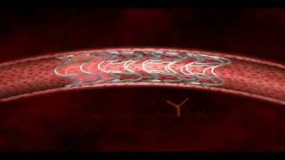 Stent 3D animation done for sahajanand medical technologies [upl. by Niwle152]