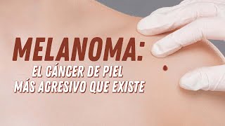 Melanoma el cancer en la piel mas agresivo que existe [upl. by Revert]