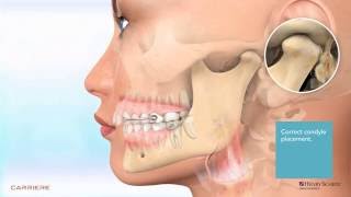 Carriere® Motion™ Appliance for Class II Patient Education Animation 2 [upl. by Laehcim]