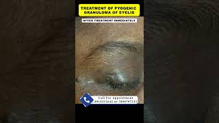 Treatment of pyogenic granuloma  By Dr Uttam Kumar Lenka MBBS MD Consultant Dermatologist [upl. by Mihar]