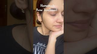 Homemade Acne Treatment skincare homemade shorts acne trending youtube [upl. by Cerys]