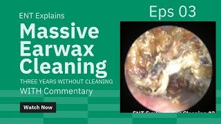 Satisfying Earwax Cleaning 3 Cholesteatoma with Commentary [upl. by Philina420]