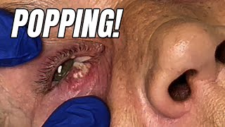 Unbelievable Transformation CJs Epic Battle with an Eye Pimple [upl. by Adnuahsal]