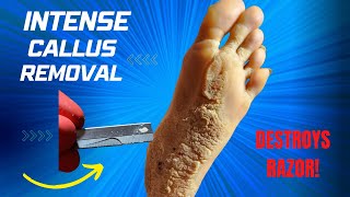 CALLUS REMOVAL [upl. by Adnaw]