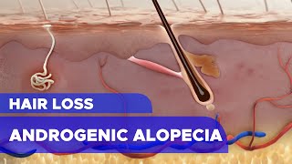 Hair Loss Androgenic Alopecia [upl. by Anaher]