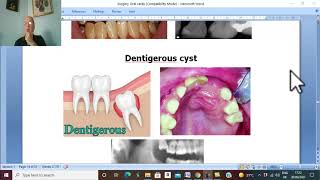 Surgical disorders of tongue and jaw in Arabic 3 Epulis  by Dr Wahdan [upl. by Castara36]