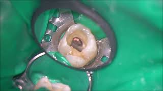 Tooth sealing  root canal sealing followed by coronal sealing [upl. by Airdnola766]