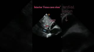 Inferior Vena cava View  short video ⚕️ [upl. by Akerley]