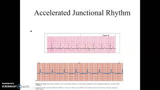 Accelerated Junctional and Junctional Tachycardia [upl. by Coppins]