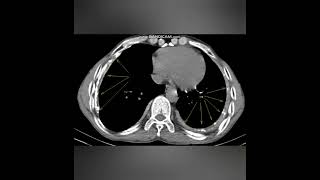 TUBERCULOUS EMPYEMACHRONIC  XRAY AND CT IMAGEA new case every daySame time tomorrow [upl. by Releehw]