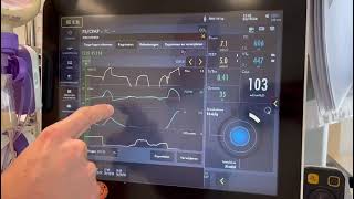 Het berekenen van de occlusie druk en predicted transpulmonaal druk ServoU [upl. by Ruy994]