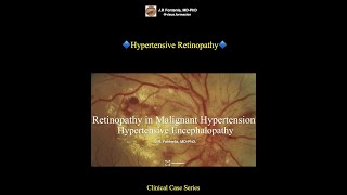 Hypertensive Retinopathy Hypertensive Encephalopathy [upl. by Sanburn]