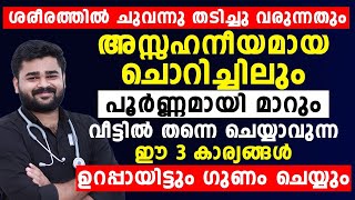 ചുവന്ന്തടിച്ചു വരുന്നതും അസഹനീയമായ ചൊറിച്ചിലും മാറാൻ ഇങ്ങനെ ചെയ്‌താൽ മതി skin allergy malayalam [upl. by Raphael121]