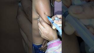 Intramuscular arm injection IM Dexamethasone injection video injectionvideo injectionfunny [upl. by Richers901]